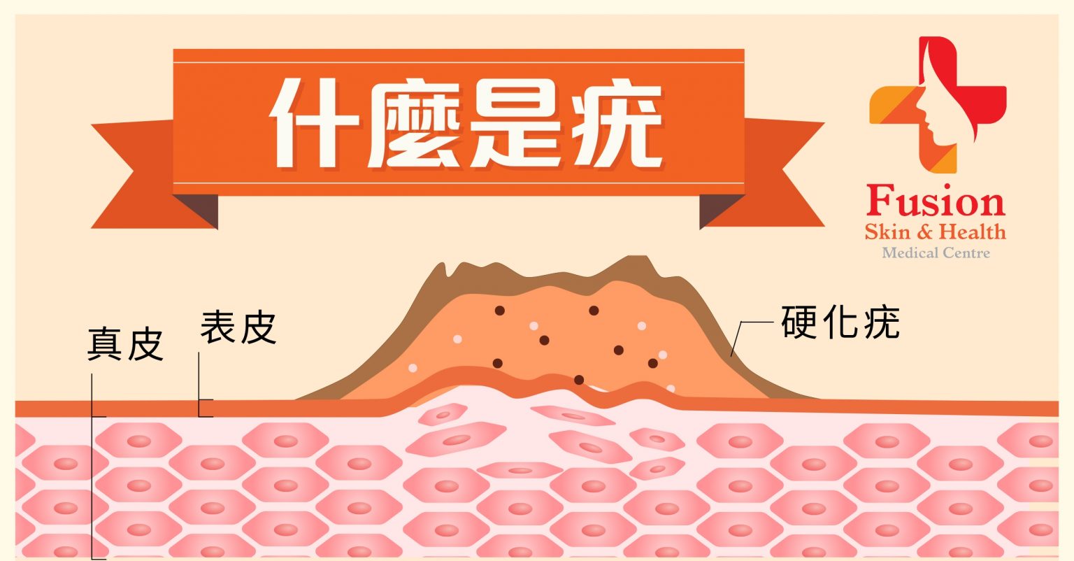 什麼是疣? - Fusion Skin & Health Medical Centre