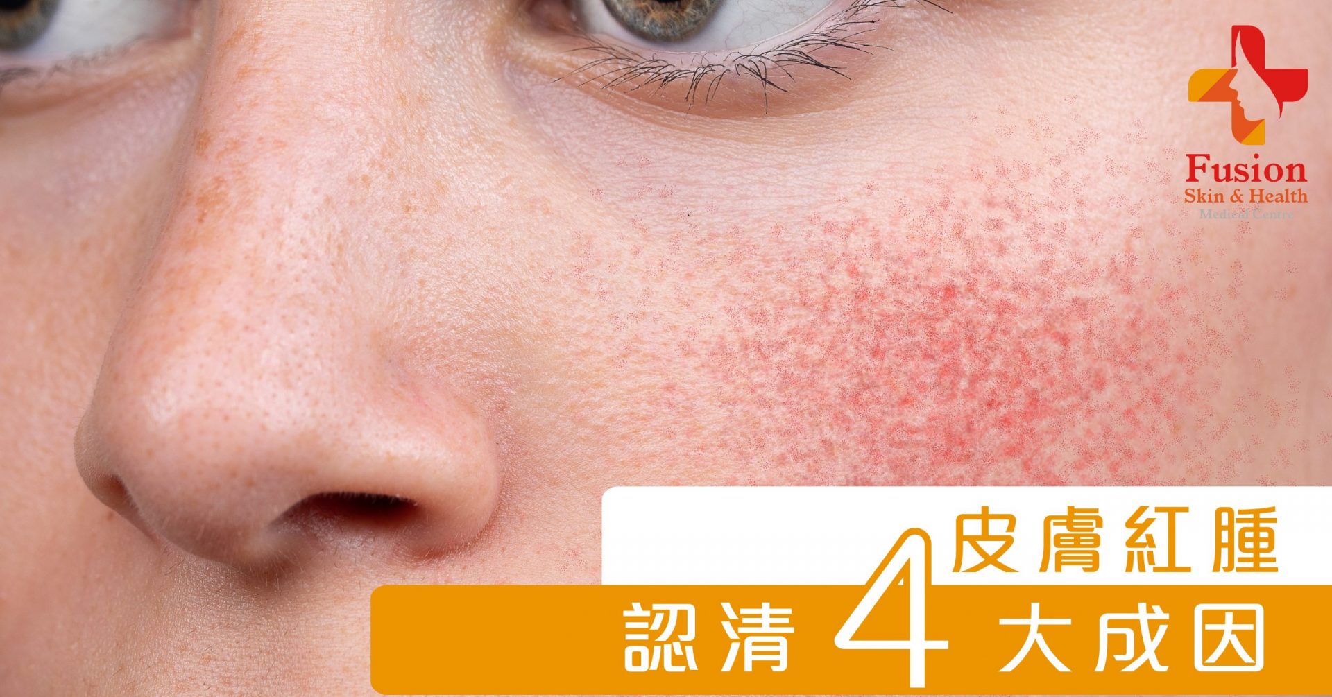臉部皮膚反覆泛紅的4個潛在原因你要知- Fusion Skin & Health Medical Centre